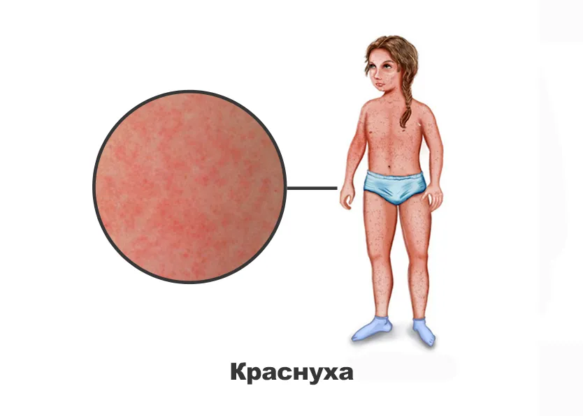 Справка о прививке от краснухи